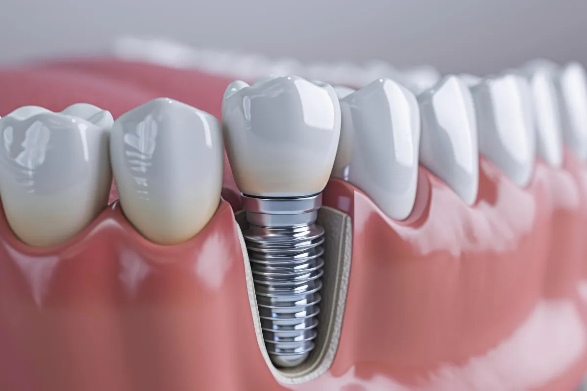 インプラント